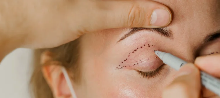 tudo sobre blefaroplastia