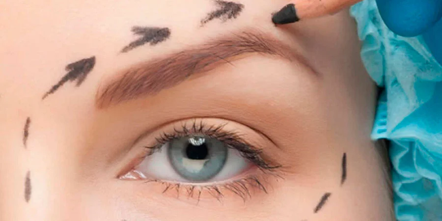 Tudo sobre levantamento de supercílios