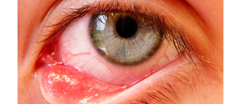 Tudo sobre correção de entrópio e ectrópio