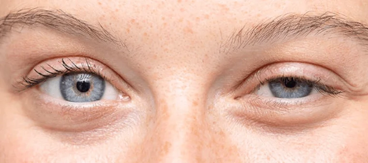 Tudo sobre correção de ptose