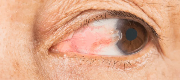 Tudo sobre cirurgia do pterígio