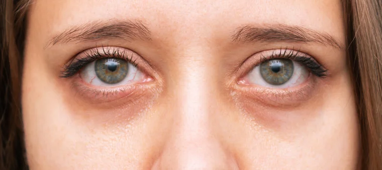 Tudo sobre tratamento para olheiras